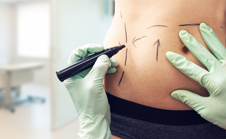 Abdominoplastia: 12 dúvidas sobre a plástica do abdome esclarecidas
