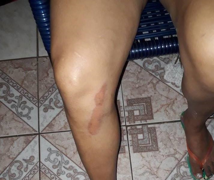 Mulher atropelada por vereador de Assis registra Boletim de Ocorrência