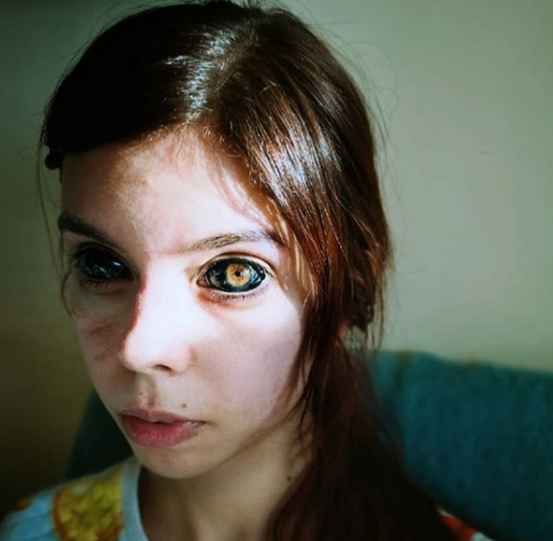 Após perder parcialmente a visão, modelo polonesa processa tatuador que pintou seus globos oculares
