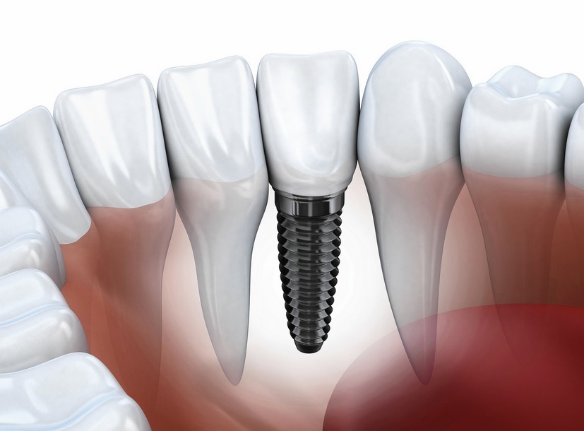 Mitos e verdades em relação aos implantes dentários