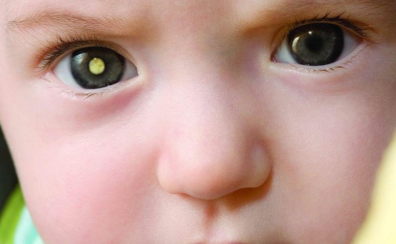 Retinoblastoma: entenda o câncer nos olhos da filha de Tiago Leifert e Daiana Garbin