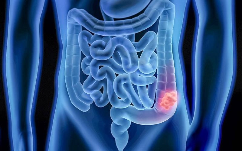 Incidência de câncer de intestino em mulheres aumenta cerca de 12%